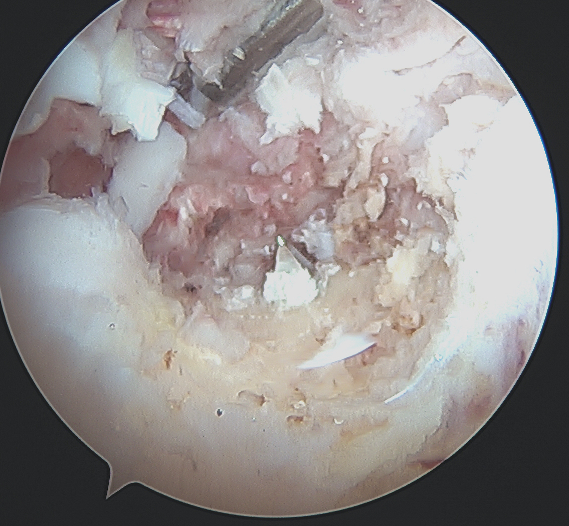 PCL tibial tunnel